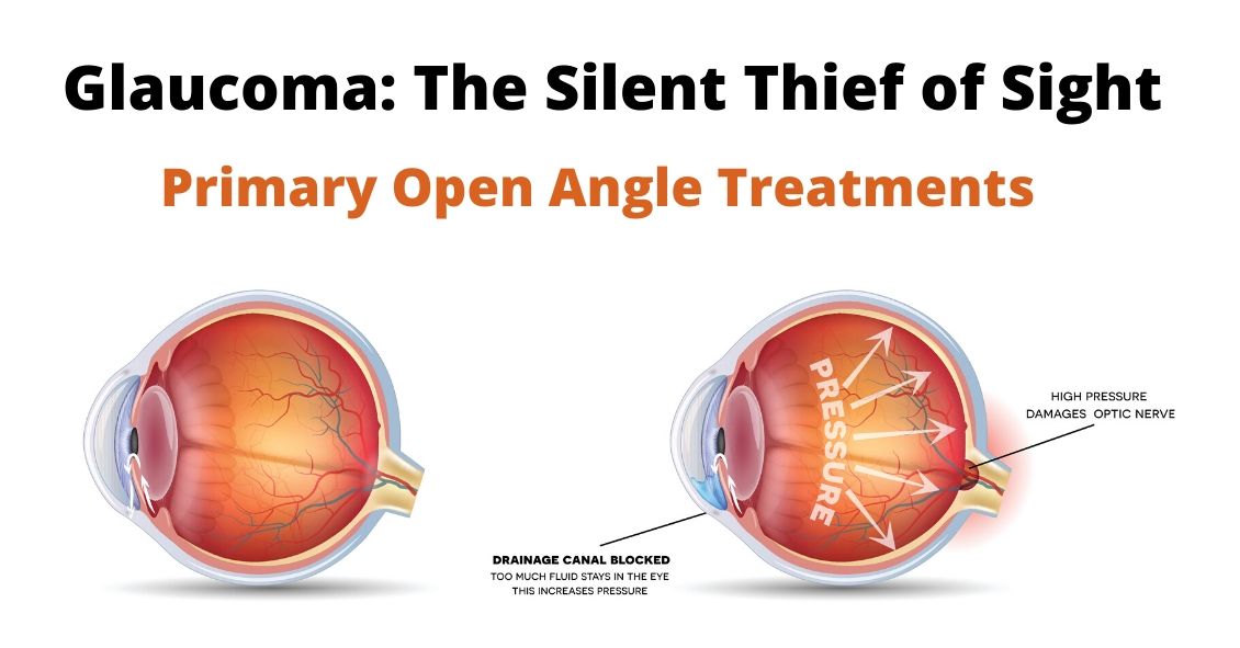 Primary Open Angle Glaucoma - La Verne Optometry